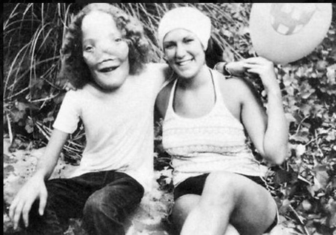 craniodiaphyseal dysplasia
